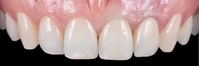 Коронки установлены, реальная работа КМ-Клиникс